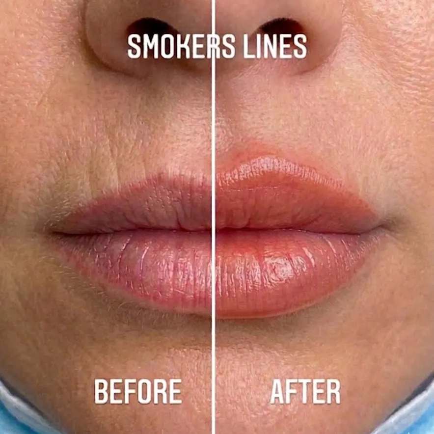 VelourLip™ - New generation lip rebalancing & plumping