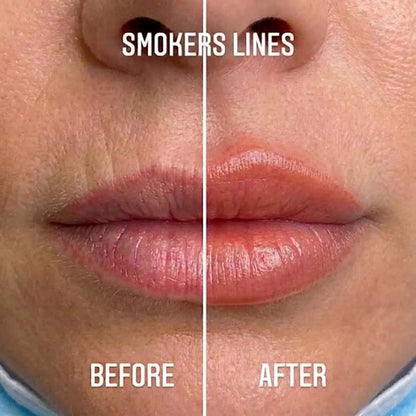 VelourLip™ - New generation lip rebalancing & plumping