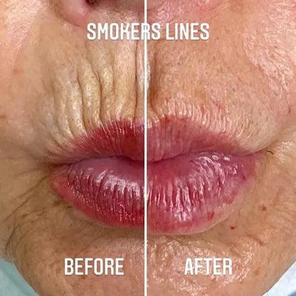 VelourLip™ - New generation lip rebalancing & plumping