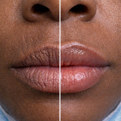 VelourLip™ - New generation lip rebalancing & plumping